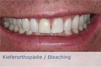 Kieferorthopädie / Bleaching Kieferorthopädie / Bleaching
